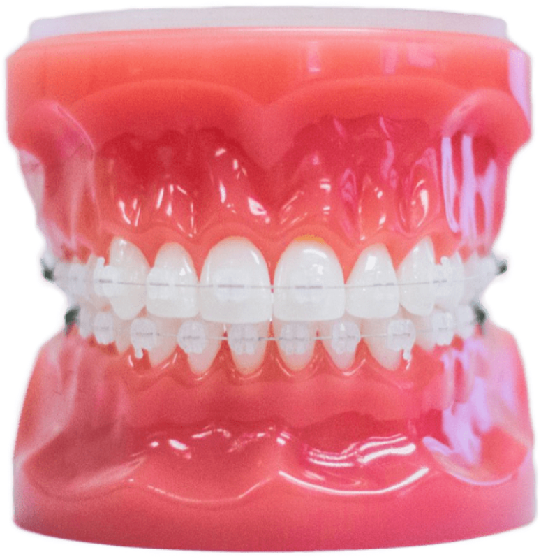 Clear Braces